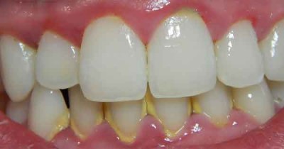 ¿Qué es el sarro dental?